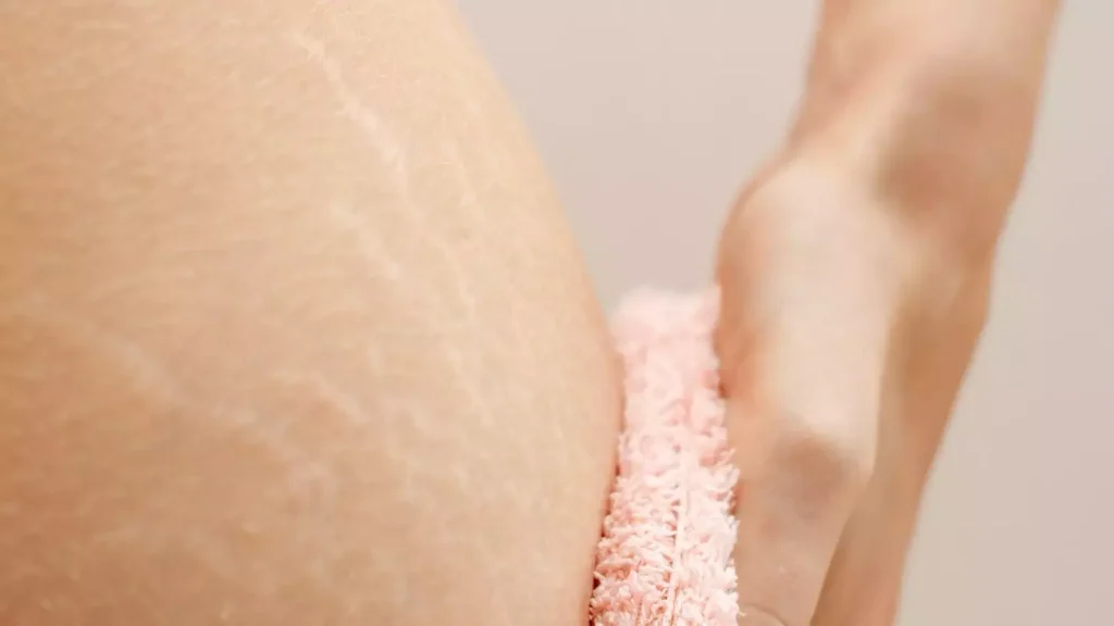 o que fazer para sumir com as estrias -